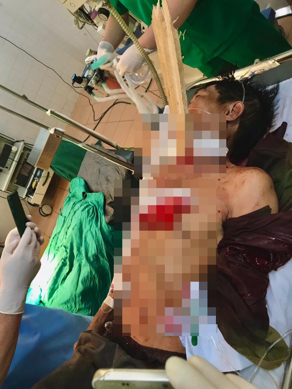 Cứu sống nạn nhân nguy kịch vì bị thanh gỗ đâm xuyên cổ - Ảnh 1.